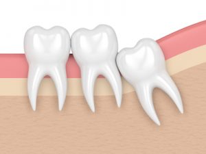 Crowded tooth needing an extraction