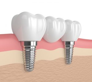 What a dental bridge looks like