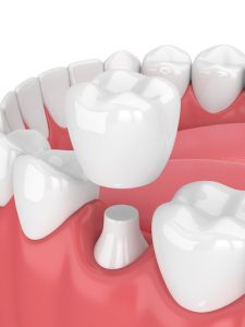 Example of a dental crown