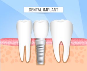Dental implant structure diagram