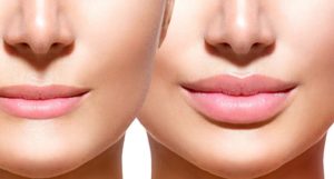 Juvederm lip injections in Anchorage