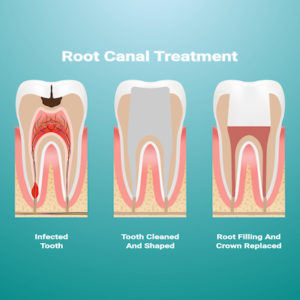Root canal therapy in Anchorage Alaska