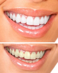 Professional dentists teeth whitening solution in Anchorage