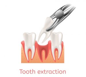 Tooth extraction example in Anchorage Alaska