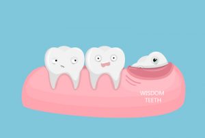 Wisdom tooth coming in and crowding other teeth